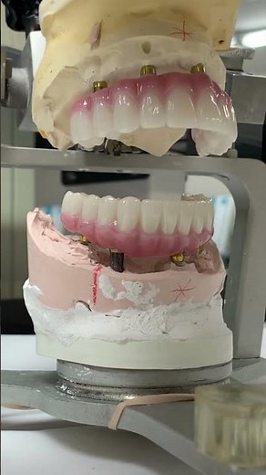 Zirconia hybrid full arch Upper and Lower prosthesis (implant bridge)
