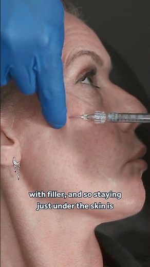 Pre Auricular Filler Injection Depth 💎 Evidence-Based Advice for Aesthetic Practitioners