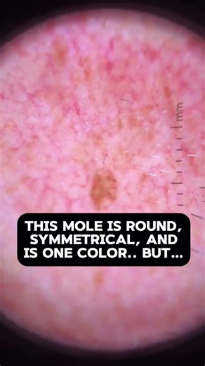 Normal appearing mole, or is it actually normal? This is not normal