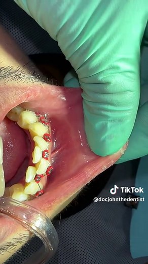 Understanding Braces: Benefits and Costs Explained