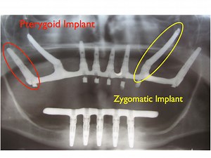 Zygomatic & Pterygoid Implants Temecula dental Implants & Oral Surgery
