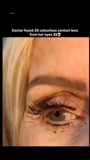 𝗂𝗇𝗇𝗈𝗏𝖺𝗍𝖾.𝗂𝗈 on Instagram: "This Instagram Reel documents a medical procedure in which an ophthalmologist removes 28 colorless contact lenses from a patient's eye. The footage shows the doctor using tweezers to extract the lenses, which had accumulated and folded within the upper eyelid's conjunctival fornix over several months due to the patient repeatedly inserting new lenses without removing old ones. The lenses, being transparent, were not immediately visible and had caused symptoms