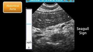 Abdominal Aortic Aneurysm