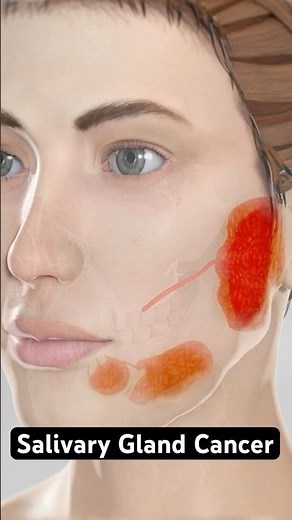 Cancer in your salivary glands (3D Animation)
