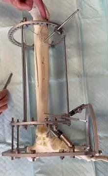 Circular External Fixation Frame Configuration Tibial/Foot Support (Dr. Edgardo Rodriguez-Collazo)