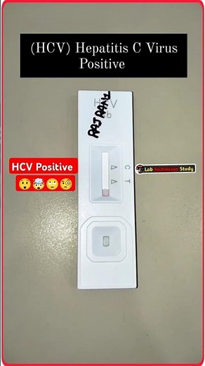 HCV Positive Test||Hepatitis C Reactive||HCV Test #serology #hcv #shorts