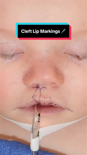 Hi 👋🏼 everyone! It’s #markingsmonday!! 🖊️🖊️ Today, I’m highlighting the intra-op markings 🖊️ of a recent right unilateral forme fruste (aka microform) cleft lip 👄 and nasal 👃🏼 reconstruction. The microform cleft lip is the most MILD type of cleft lip. Just like other types of cleft lips, microform cleft lips can be unilateral (right or left), bilateral, or asymmetric bilateral. This type of cleft can be characterized by downward depression of the alar rim, skin striae of the upper lip (o