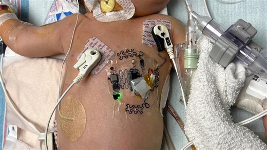 Wearable Sensors to Monitor Congenital Heart Disease