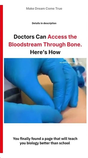 🦴 Doctors Can Access the Bloodstream 🩸 Through Bone. Here’s How 🧑🏻‍⚕️ | MDCT