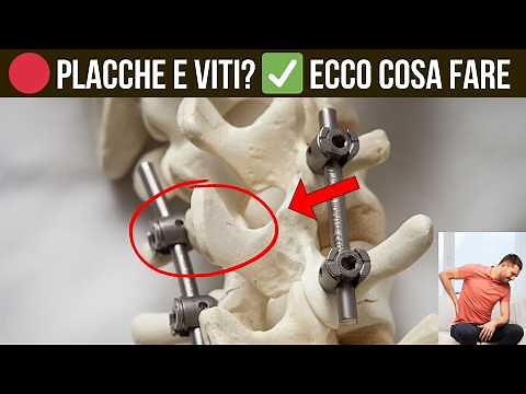 Rehabilitation after back plates and screws: exercises and tips