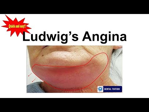 Ludwig's Angina in detail | Oral surgery| General Surgery| Dentalnotes