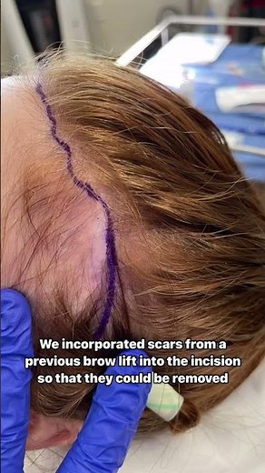 Brow Bone Reduction for Women | Dr. Sarah Saxon