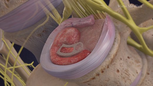 What is a Transforaminal Lumbar Interbody Fusion (TLIF)? - Spine Connection