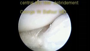CENTRAL TFCC DEBRIDEMENT (No Audio)