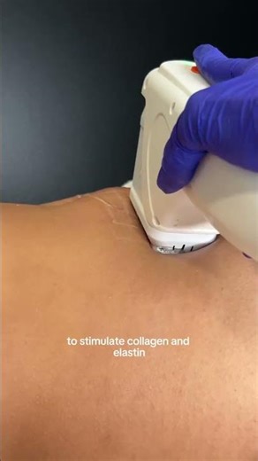 Stomach Skin Tightening with LIPOSculpt (Body HIFU)