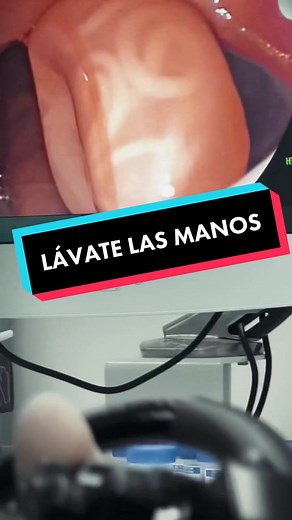 Lavate las manos #ascarislumbricoides #ascariasis #ascaris #endoscopia #gastroenterologia #anestesia #estudiantedemedicina #medicina