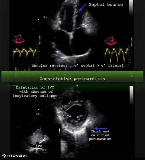 Constrictive pericarditis(s)