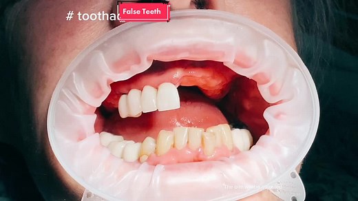 🦷False teeth🦷- just click them in! That sense of security- knowing they are not going to drop out! 🤩 #falseteeth #clickinteeth #instantteeth #dental #traceybell #fyp #secure #denture #dentureconfidence #dentist #toothadvice #toothadvisor #beautiful #teeth #experience #noworries #cleanteeth #viral #wontdropoff #isleofman 🤩