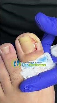 TREMENDO!! Pedazo de uña que traía encarnada #ingrowntoenail #uñero #uñaencarnada