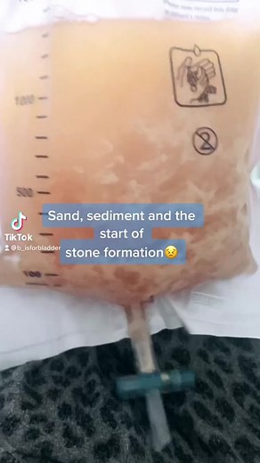 Managing Bladder Health: A Daily Routine for Stone Prevention