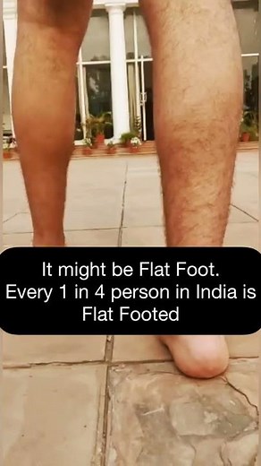 How Flat Foot walk looks like ? Flat Foot Symptoms - Overpronated Feet