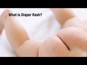 How do I Treat Diaper Rash - Everything You need to Know about Diaper Rash