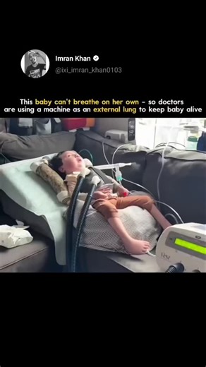 𝗜𝗠𝗥𝗔𝗡 𝗞𝗛𝗔𝗡 ❤ on Instagram: "This video shows the incredible story of a baby who cannot breathe on her own. 💔 Her tiny lungs are too weak to take in oxygen, so doctors have connected her to a life-support machine that works like an external lung. This machine, known as ECMO (Extracorporeal Membrane Oxygenation), takes the baby’s blood out of her body, adds oxygen to it, removes carbon dioxide, and then pumps the clean blood back in — just like healthy lungs would do. 🫁 It’s one of the 