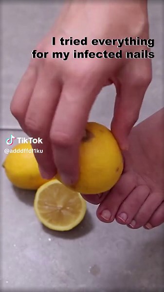 Say goodbye to nails fungus with this amazing tea tree oil#nails #nailfungus #nailsalon #nailcare #teatreeoil #fyp #foryou