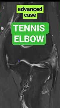 Partial tear in TENNIS ELBOW #MSK #Radiology #MRI #Case #Teach #Review#athlete#trauma#tennis#elbow