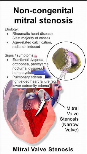 Mitral stenosis in adults