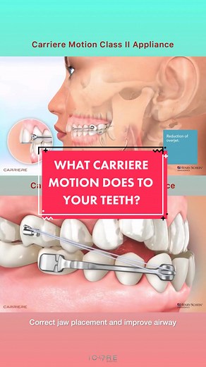 What Carriere Motion Appliance does to your teeth? Video credit : Henry Schein Orthodontics #icaredentaldh #dentist #dental