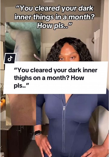 Effective Solutions for Dark Inner Thighs Hyperpigmentation