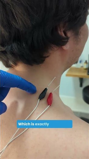 How Electro Acupuncture Actually Helps You Heal ⚡️