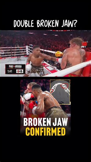 These are the full highlights from the boxing match last night AND it doesn’t hurt to review some mandible anatomy either. Anthony Joshua defeated Jake Paul in their heavyweight fight in Florida on Friday night; the American went to hospital with a “double broken jaw” and later confirmed he had undergone surgery after he was stopped in six rounds by the British fighter 👊🏼🫣 #anatomy #boxing #jakepaul #medical | REV MED