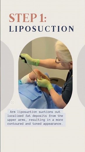 Renuvion Skin Tightening with Liposuctions - Arms