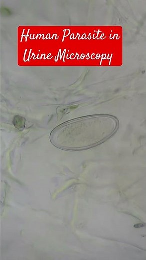 Human Parasite in Urine Microscopy | Egg of Enterobius vermicularis | Pinworm