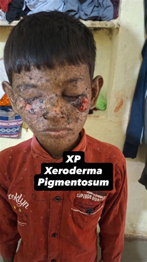 Dr. Jainith Lowvanshi | MBBS•MD•DNB (India 🇮🇳) on Instagram: "☀️ When sunlight becomes dangerous… Xeroderma Pigmentosum (XP) is a rare genetic condition where even small amounts of UV rays can cause severe skin damage, early aging, and increase the risk of skin cancer. 🩺 Key facts: 🔹 Extreme sensitivity to sunlight 🔹 Dry, freckled skin from childhood 🔹 Eye irritation & damage 🔹 Requires strict sun protection Early diagnosis = safer life. If you notice unusual skin changes after sun exposu