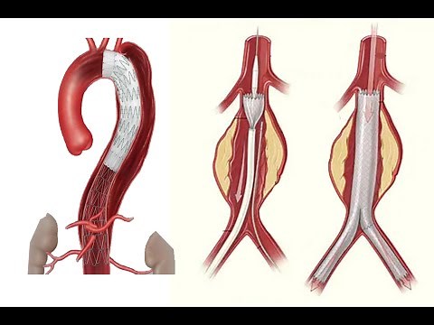 ENDOPROTESIS PARA TRATAMIENTOS DE ANEURISMAS DE AORTA
