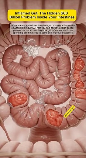Inflamed Gut: The Hidden $60 Billion Problem Inside Your Intestines