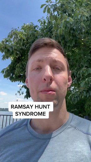 Understanding Ramsay Hunt Syndrome Recovery Process