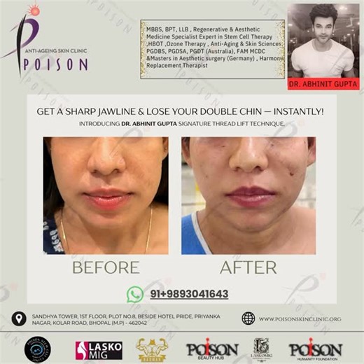 LASKOMIG on Instagram: "✨ Dr. Abhinit Gupta Signature Thread Lift Technique ✨ Get a sharper jawline, reduce your double chin, and enhance your natural facial contour — instantly. This advanced minimally invasive thread lift technique is designed to: ✔️ Sculpt & define the jawline ✔️ Lift sagging tissue ✔️ Reduce double chin fat ✔️ Give long-lasting results (10–15 years*) ✔️ No scars • No downtime • Instant transformation Performed exclusively at Poison Stem Cell Clinic & Research Center, Bhopal,
