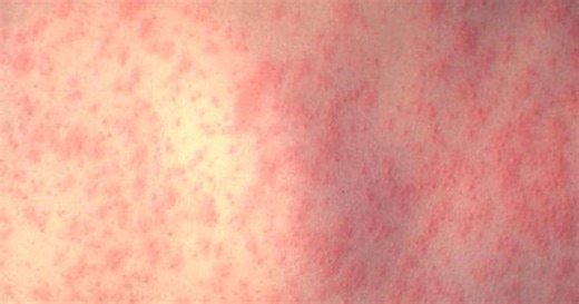 Here's what you need to know about measles, according to doctors