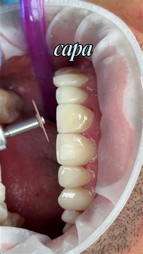 El secreto de una sonrisa natural está en los detalles 👀🦷