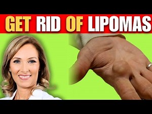 How To Get Rid of Lipomas | Dr. Janine
