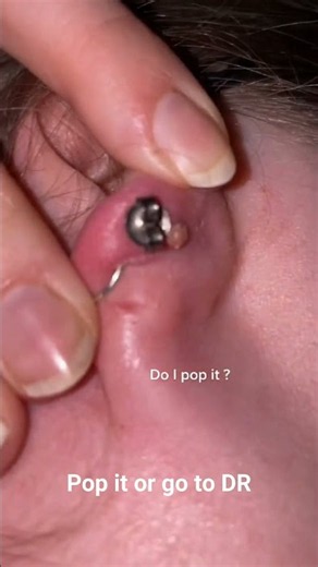 Pop it or go to DR