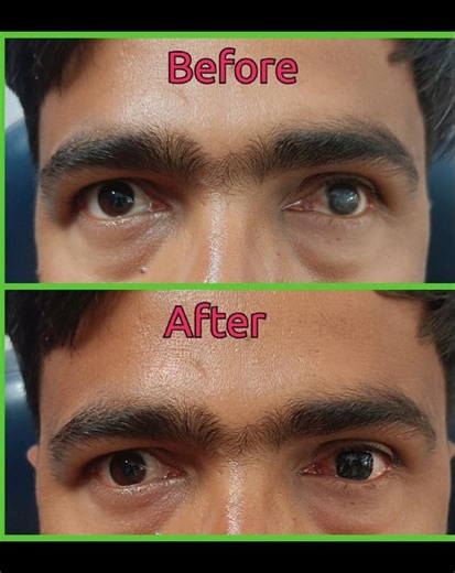 Prosthetic Contact Lens (Cosmetic Lens )#optometrist #youtubeshorts