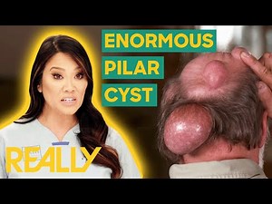 Dr Lee Removes Three Huge Bumps From A Man's Head | Dr. Pimple Popper: Pop Ups