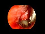 Endoscopic Stapedotomy • Video • MEDtube.net
