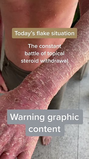 Today’s flake situation (Warning graphic content) #topicalsteroidwithdrawal #nomoisturetreatment #nmt #tsw #fyp #ezcema #itch #ctrlskin