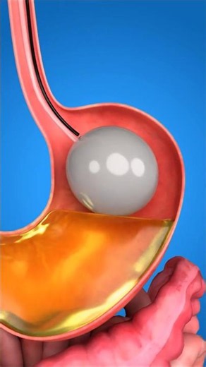 Gastric Balloon: The Shocking Weight Loss Secret #shorts